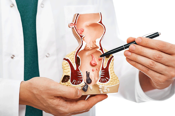 Fistula